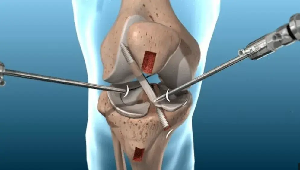 Chirurg wykonujący artroskopię kolana przy użyciu kamery i narzędzi medycznych, z obrazem kolana wyświetlanym na monitorze